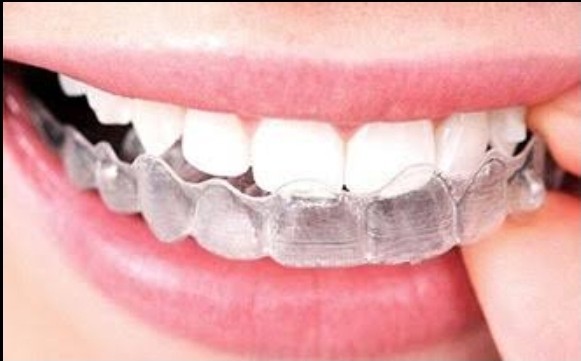 Link Between Invisalign and Gum Health